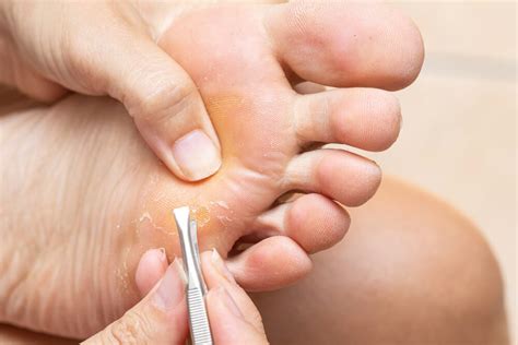 7 remedies for foot calluses and corns step to health