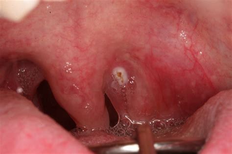 Oral Human Papillomavirus Hpv Removal Cape Dental Care