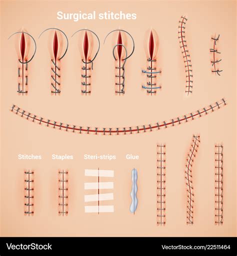 surgical stitches infographic set royalty  vector image