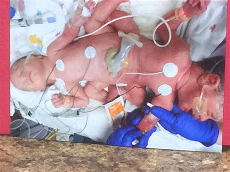 photos identical triplets born in texas hospital includes set of conjoined twins