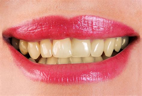 do teeth whitening strips work on fillings teethwalls
