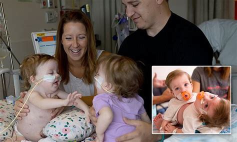 conjoined 14 month old twins born locked in an embrace are successfully