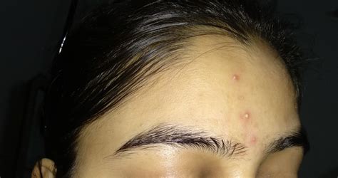 Forhead Small Acne With Pus – General Acne Discussion – Forum
