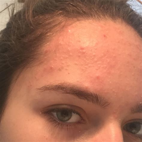 hundreds of forehead bumps i can t get rue of general acne discussion