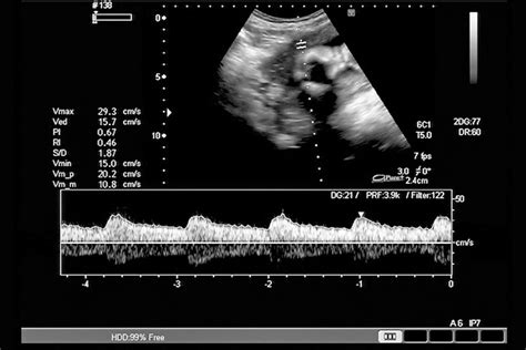 fetal heartbeat week by week chart and methods used to monitor it