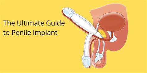 The Ultimate Guide To Penile Implant