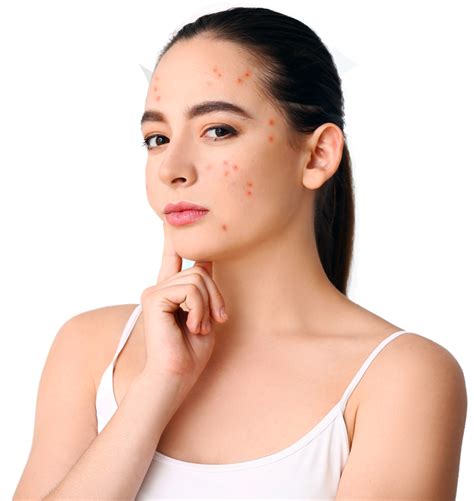 Adult Acne A Guide To Help You With The Condition To Improve Confidence