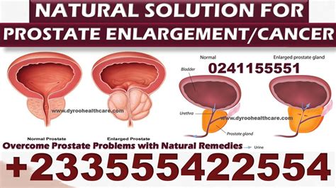 Natural Remedies For Prostate Cancer And Enlargement Health Articles