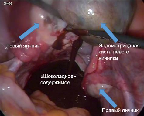 Endometrial Cyst Of The Ovary All Information About Cysts
