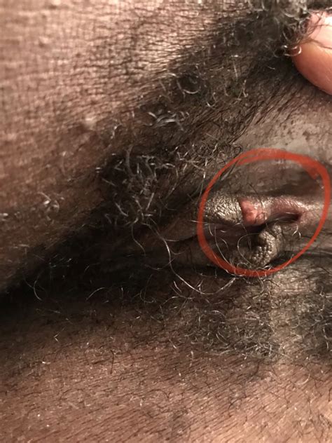 Help Is This Genital Herpes Or Something Else Pics Included