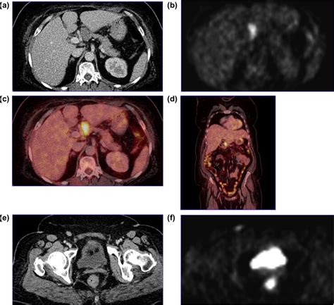 Lymph Node Metastasis In A 55year Old Female Patient With Ovarian