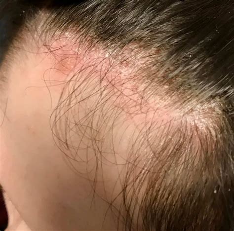 list  pictures show pictures  scalp psoriasis stunning