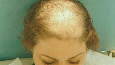 homeopathy for female baldness ccube homeopathy
