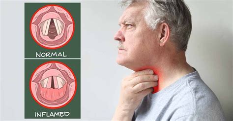 vocal cords  voice box  inflamed laryngitis occurs   infection