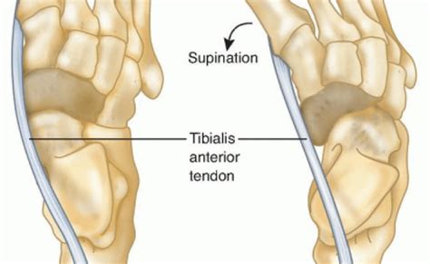 Anterior Tibialis Transfer For Residual Clubfoot Deformity Otosection