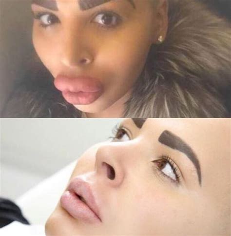 kim kardashian wannabe has cosmetically enhanced pout reduced after