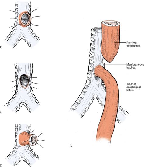 Tracheoesophageal Fistula And Esophageal Atresia Repair Basicmedical Key