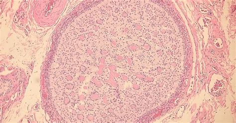 Sex Cord Stromal Tumor With Annular Tubules Sctat Imgur