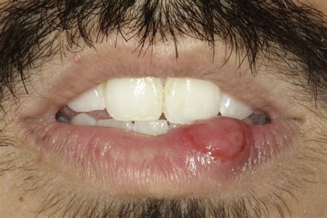 chronic ulcerative lesion   lip  journal   american dental association