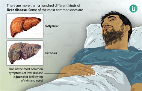 Liver Disease Symptoms Causes Treatment Medicine
