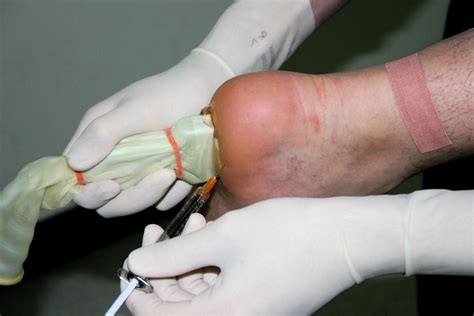 ultrasound guided corticosteroid injection for plantar fasciitis
