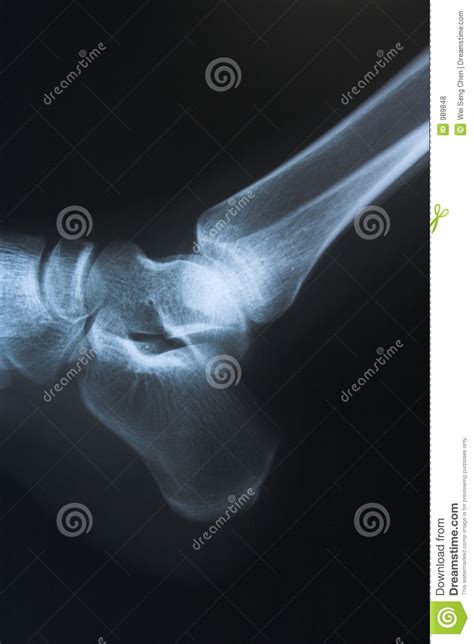 ankle  ray stock photo image  film fracture ankle