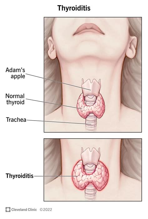 thyroid  symptoms  treatment public health notes