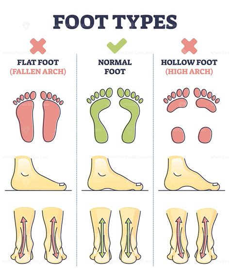 foot types  flat normal  hollow feet comparison  outline