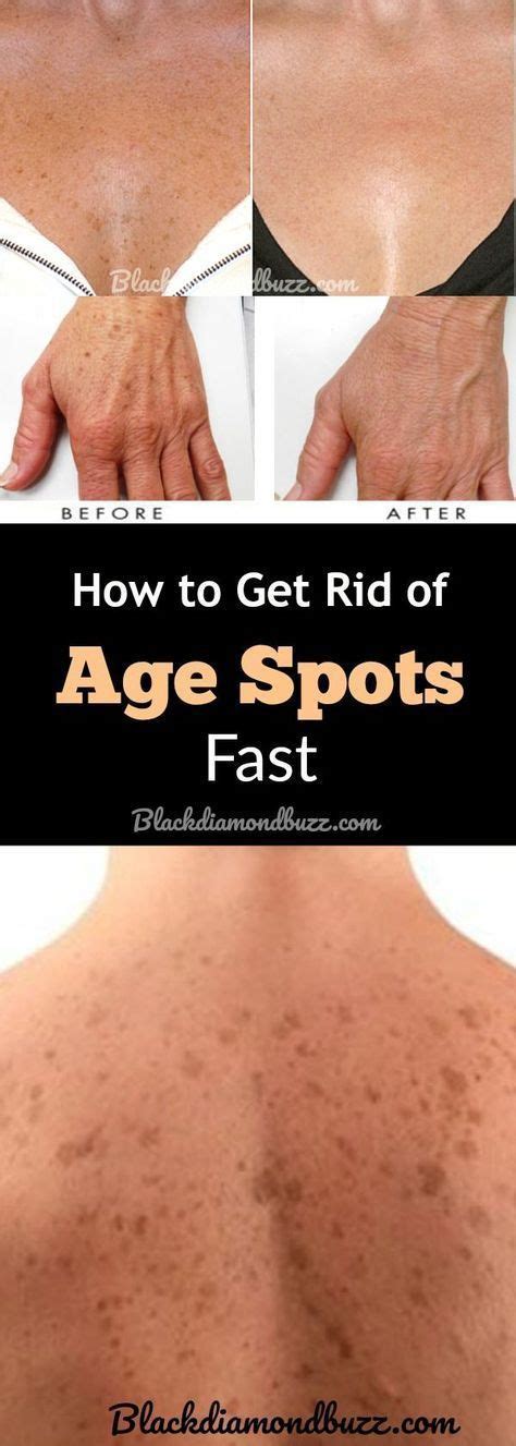 diy age spots removal cream how to get rid of age spots brown spots