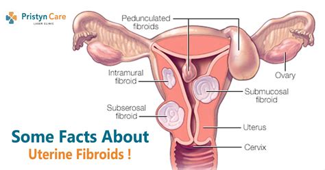 Some Facts About Uterine Fibroids