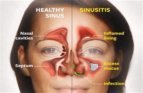 kill sinus infection   seconds   simple method