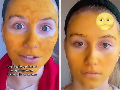 woman regrets wearing turmeric face mask  acne  face turns orange   weeks dimplify