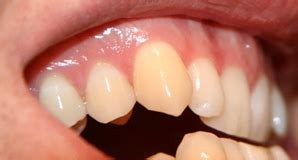 slijtage van het gebit tandarts tandmere almere poort