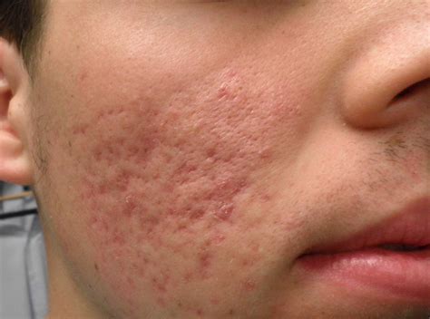 acne marks   health news