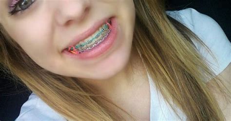 green braces braces colors pinterest green braces