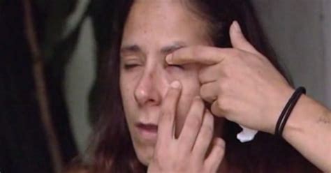 a woman mixed up her eye mdrops with superglue and glued her eye shut