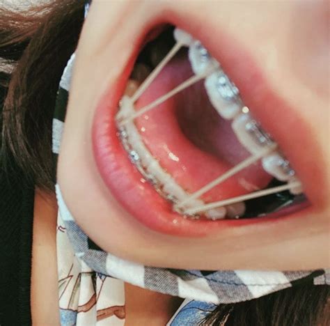 pin by larry greenstein on braces braces girls cute braces braces tips