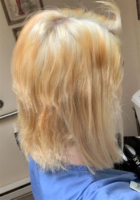 Teen S Hair Melts And Falls Out After Home Bleaching Goes Disastrously