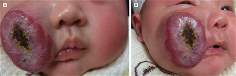 demographic and clinical characteristics and risk factors for infantile hemangioma a chinese