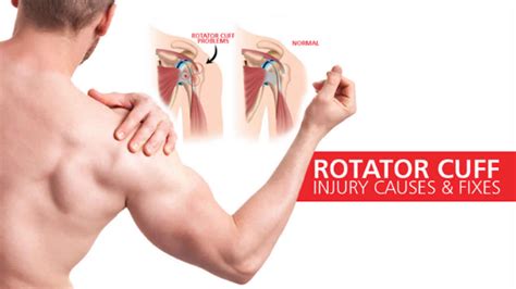 rotator cuff injury  signs symptoms diagnosis  treatment