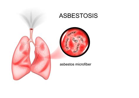 what is asbestosis disease lung cancer lawsuit lawyers pintas