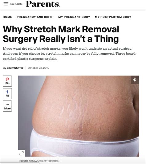 How To Remove Stretch Marks Treatment