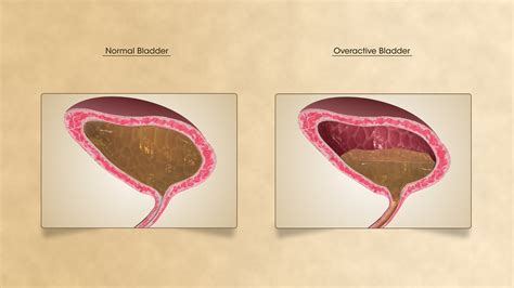suffering  overactive bladder scientific animations