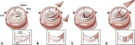Ross Operation Or Aortic Valve Repair In Neonates And