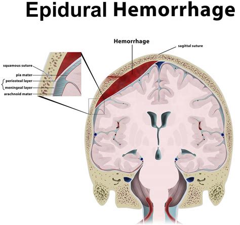 epidural hematoma  signs symptoms diagnosis treatment