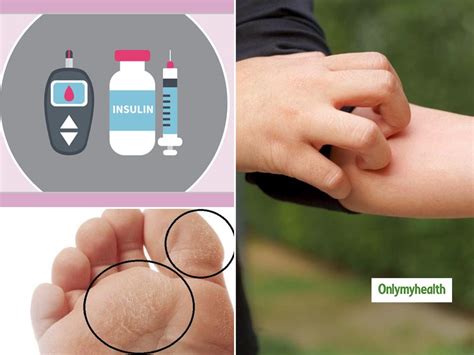 diabetes  skin infections    diseases caused   onlymyhealth