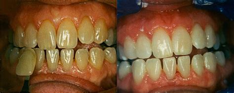 Before And After Dentist Manhasset Ny Golden Dental