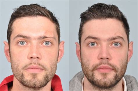Transplant Of Neck Hair To Create A New Eyebrow Huffpost Uk Life