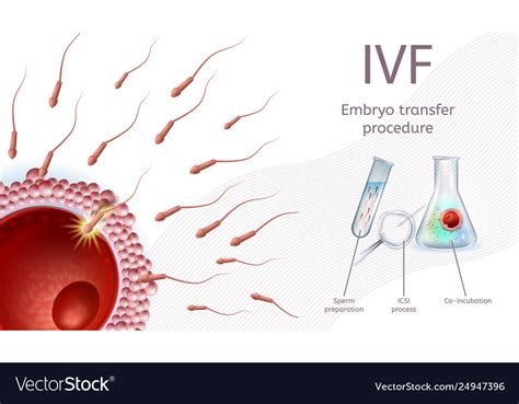 in vitro fertilization embryo transfer procedure vector image