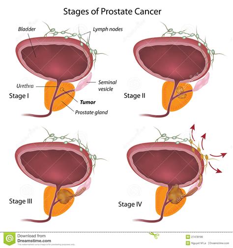 stages of prostate cancer royalty free stock image image